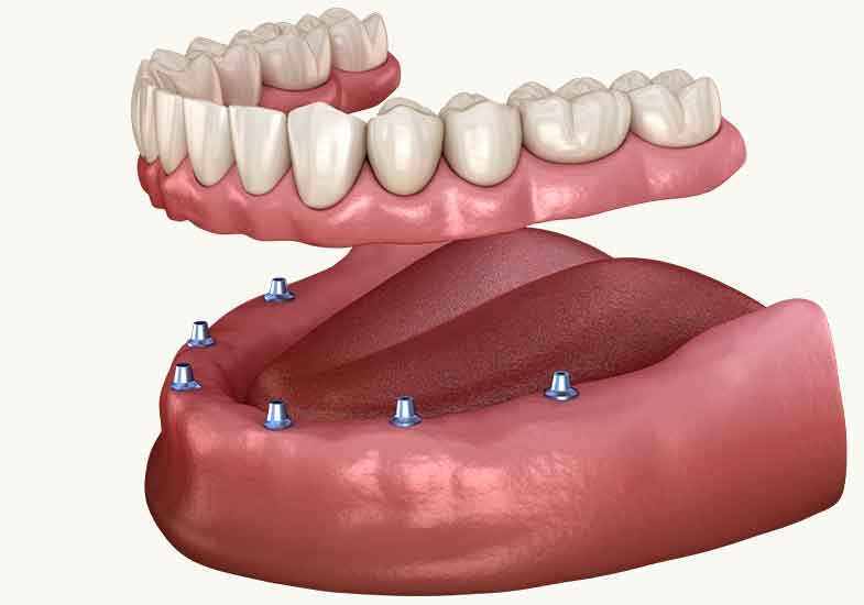 Dentures With Implants