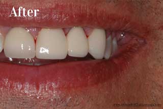 Dental Bridges Chattanooga Tennessee - After