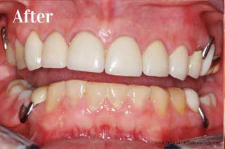 Dental Crowns Chattanooga - After
