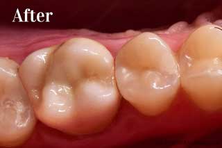 Dental Crowns Chattanooga TN - After