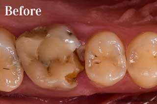 Dental Crowns Chattanooga Tennessee - Before