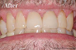 Dental Crowns Chattanooga Tennessee - After