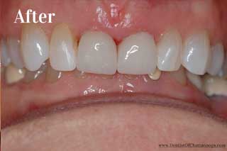 Dental Crowns In Chattanooga - After