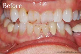 Dental Crowns Chattanooga TN - Before