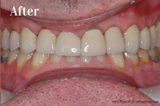 Dental Crowns In Chattanooga TN - After