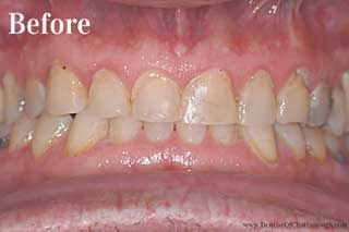 Dental Crowns Chattanooga - Before