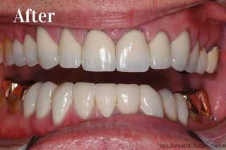 Full Mouth Reconstruction Chattanooga TN - After