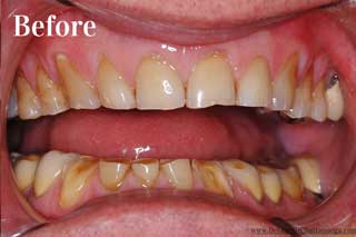 Full Mouth Reconstruction Chattanooga TN - Before