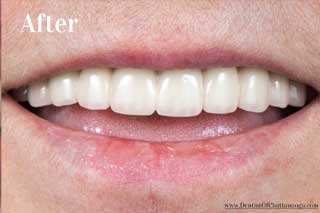 Dental Implants Chattanooga - After
