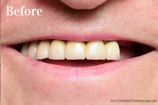 Dental Implants Chattanooga - Before
