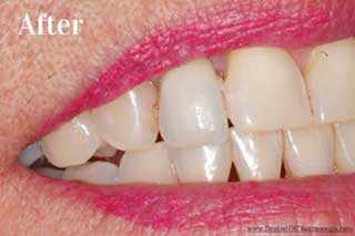 Dental Implants Chattanooga TN - After