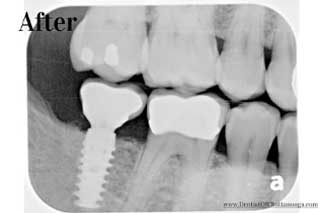 Dental Implants X Ray Chattanooga TN - After
