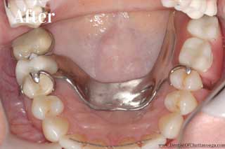 Paticial Dentures Chattanooga - After
