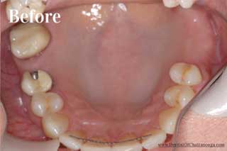 Paticial Dentures Chattanooga - Before