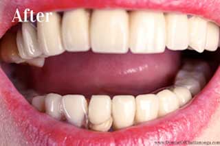 Paticial Dentures Chattanooga TN - After