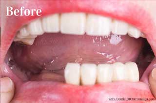 Paticial Dentures Chattanooga TN - Before