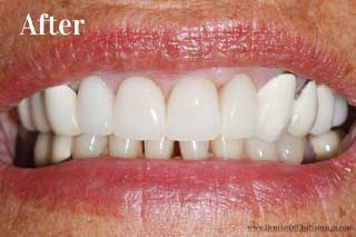 Paticial Dentures Chattanooga Tennessee - After