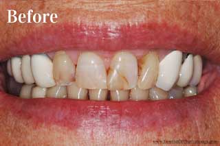 Paticial Dentures Chattanooga Tennessee - Before