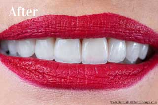 Porcelain Veneers Chattanooga Tennessee - After