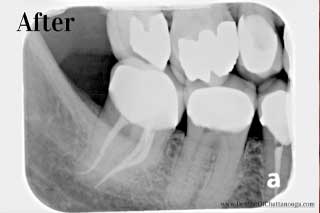 Root Canal Chattanooga - After