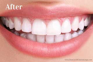 Teeth Whitening - After