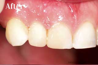 Tooth Colored Fillings Chattanooga Tennessee - After